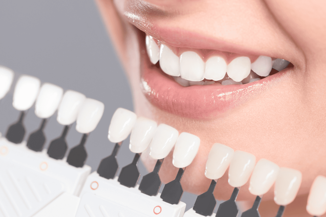 The Role of Tooth Preparation in Natural-Looking Veneers