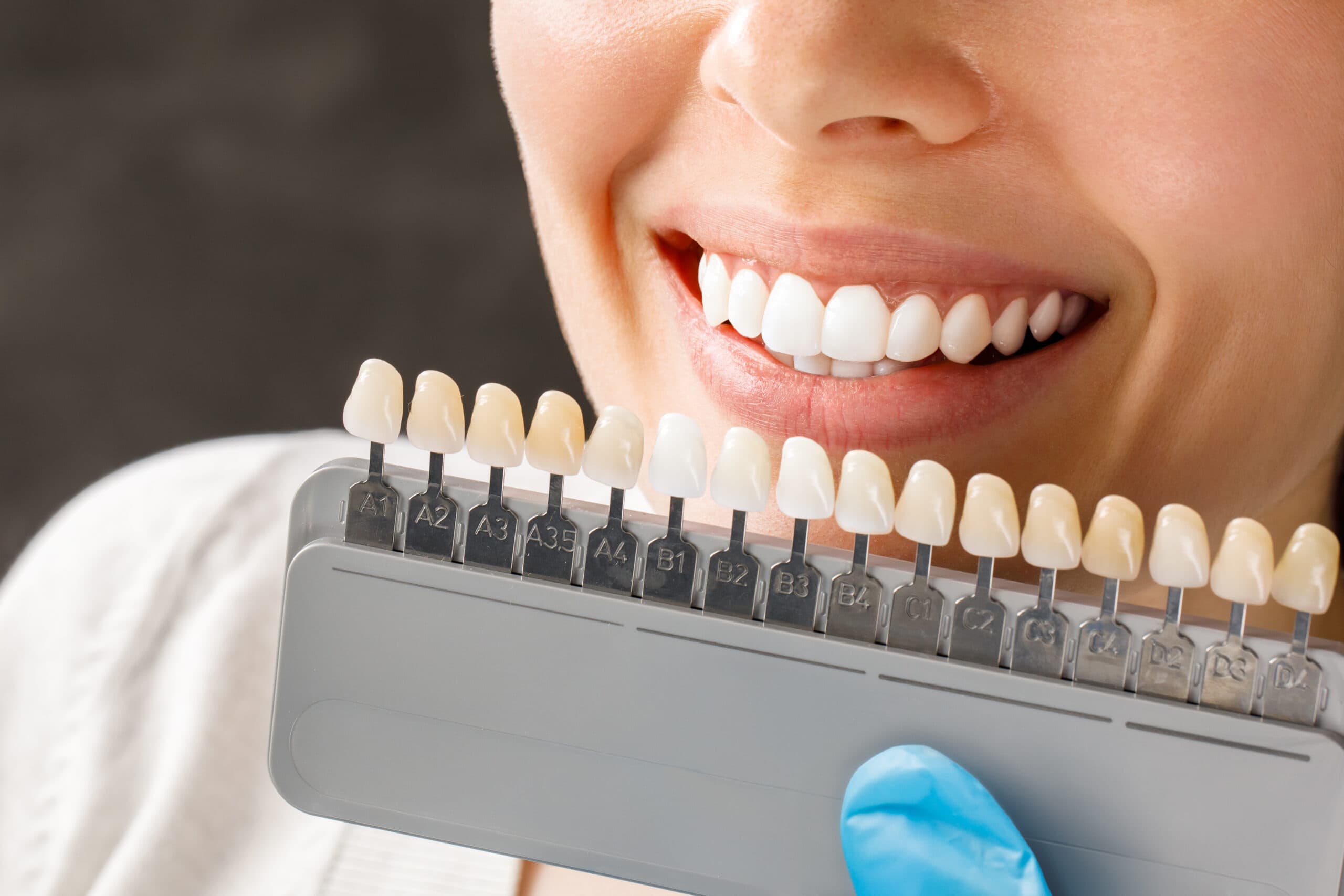 Weighing Options: Veneers Versus Crowns for Durable Dental Health