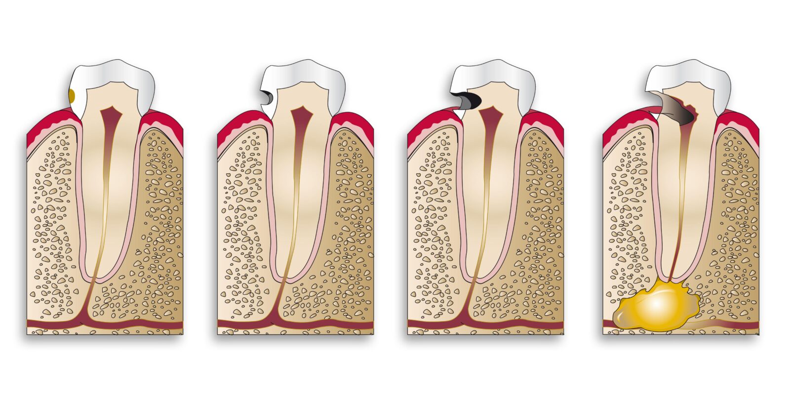 Navigating the Layers of Tooth Decay: From Enamel Erosion to Pulp Preservation Strategies