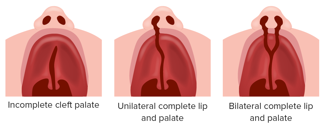 Navigating Comprehensive Dental Care for Cleft Palate: A Multidisciplinary Approach