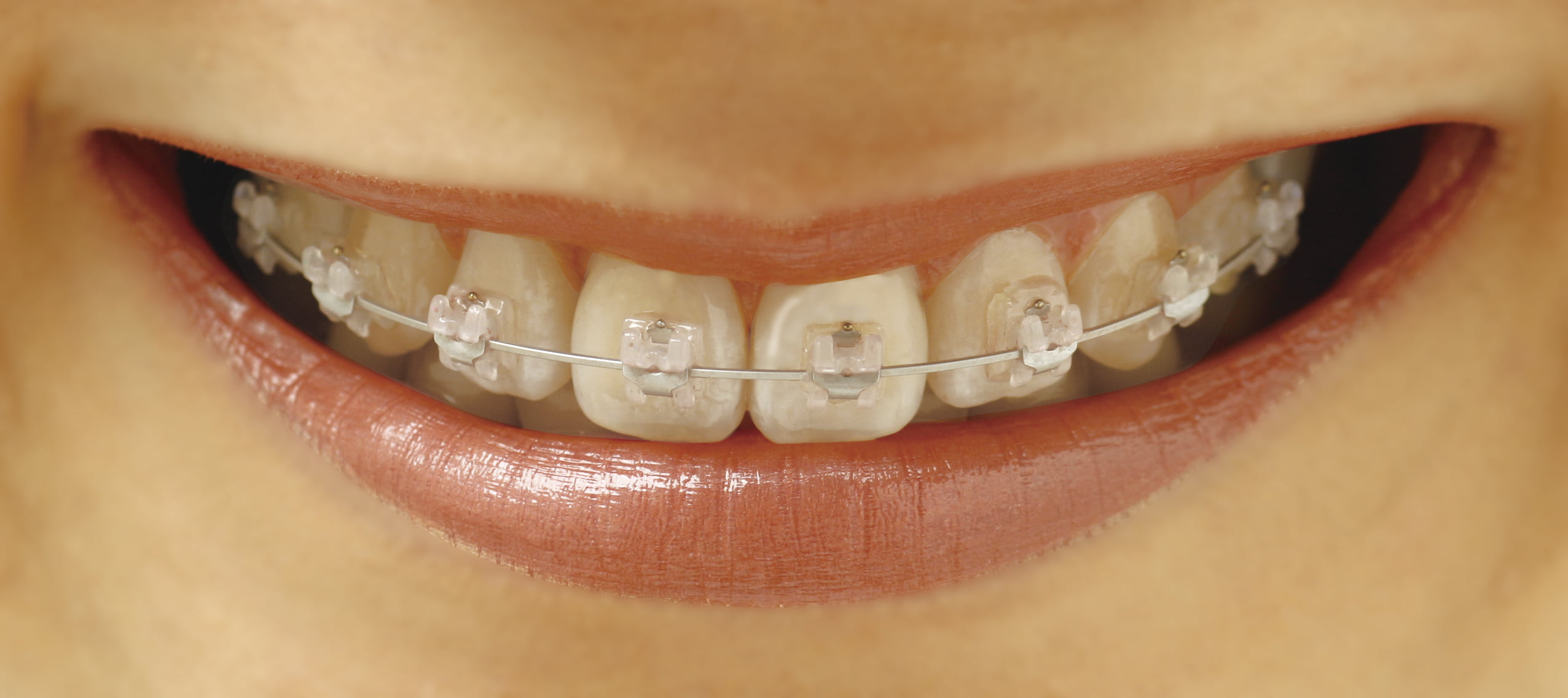 Exploring the Evolution of Archwire Materials: A Fusion of Strength and Flexibility