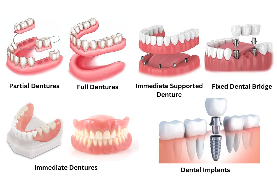Exploring the Diverse World of Dentures