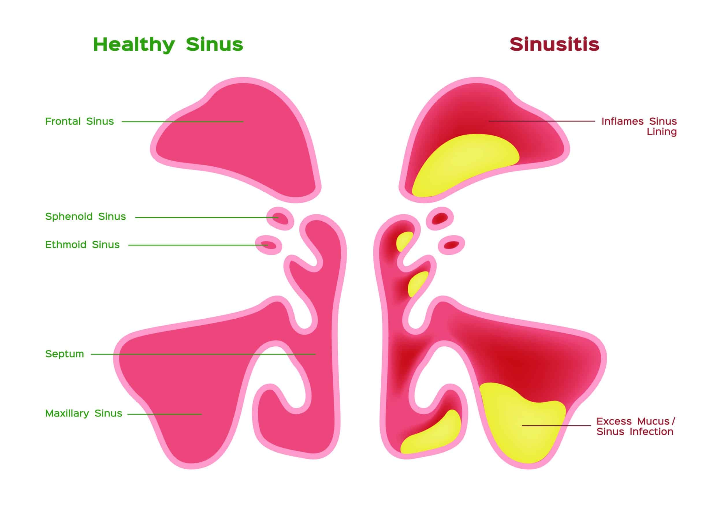 How Seasonal Allergies Intensify Maxillary Sinusitis and Dental Pain