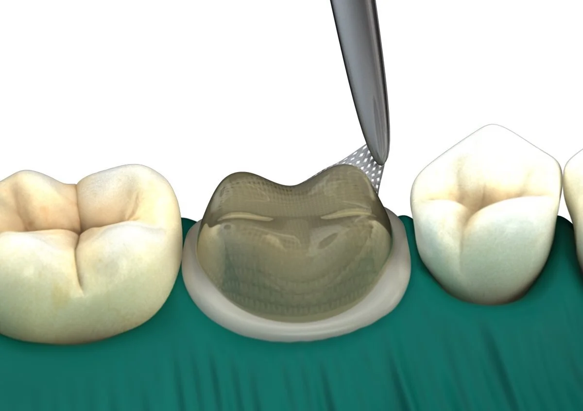 Unveiling the Intricacies of Microleakage: From Marginal Integrity to Sweet Sensitivity
