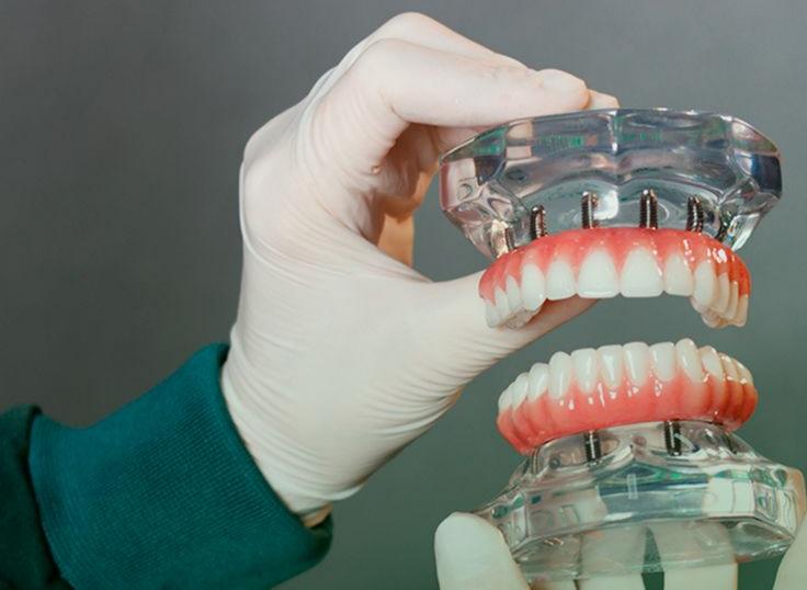 Do Valor Popular Ao Antes E Depois: O Verdadeiro Custo Do Implante Dentário