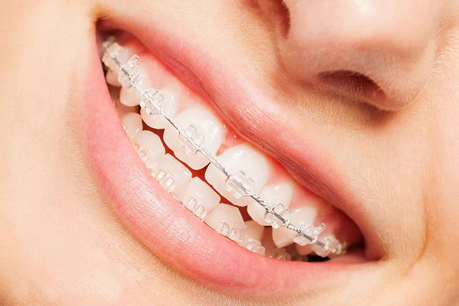 Revolutionizing Orthodontics: The Future of Customized Braces