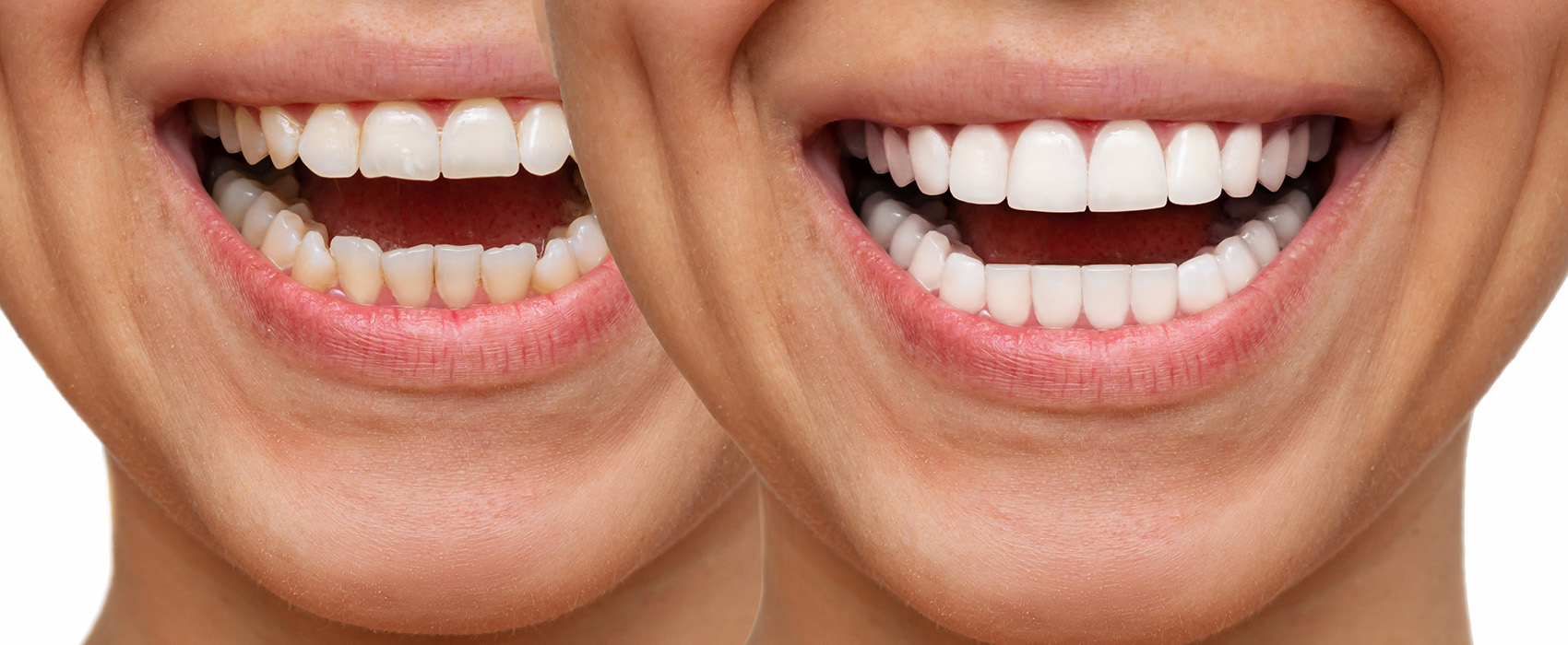 Preserving Enamel with No Prep Veneers: Strategies and Risks