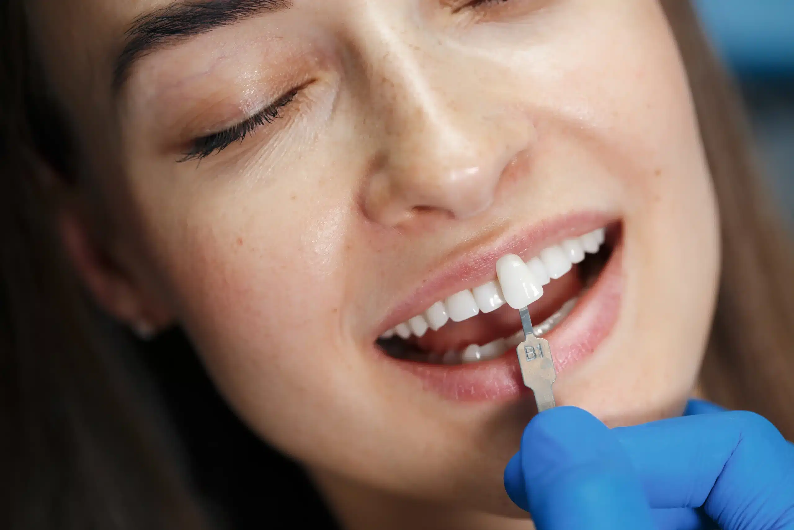 Crafting Smiles with Veneers: A Delicate Dance of Preservation and Beauty