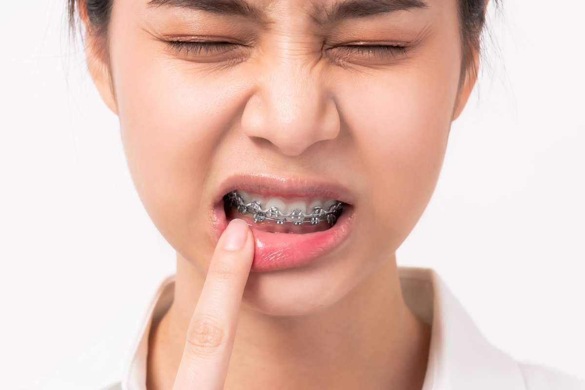 Unraveling Orthodontic Discomfort: From Bracket Friction to Aligner Tightness