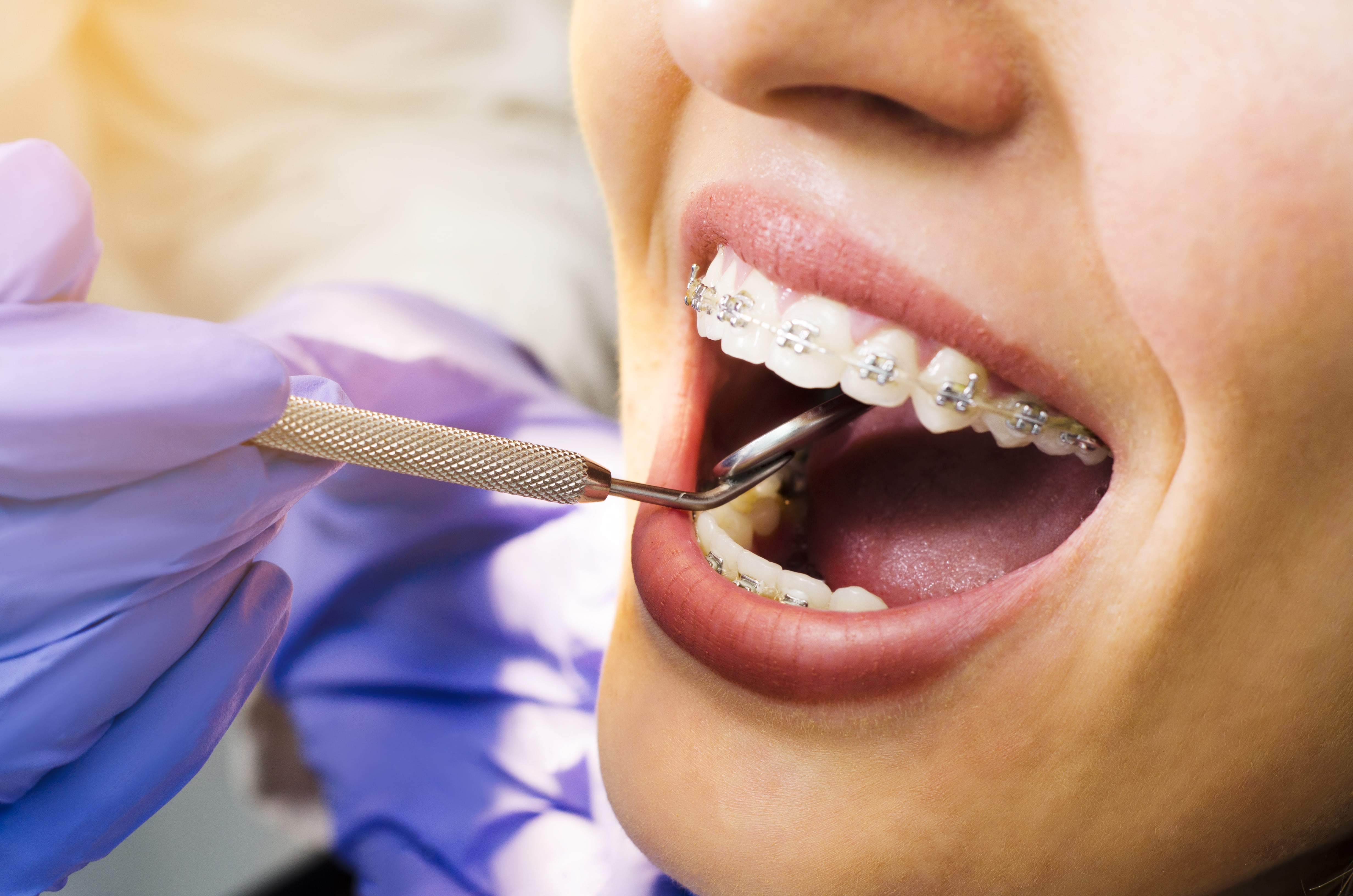 The Hidden Forces Behind Braces: Unraveling Tooth Movement Mechanics