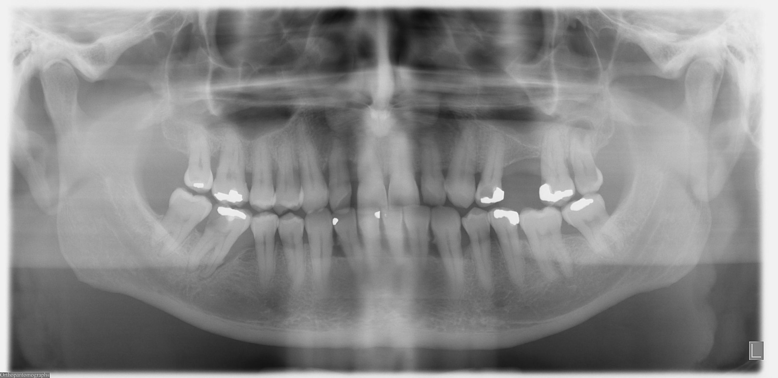 Unraveling the Complexities of Periodontal Abscess and Its Impact on Oral Health