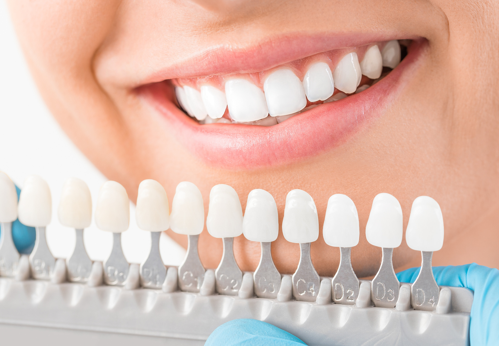 Beyond Aesthetics: Crafting the Perfect Smile with Porcelain Veneers