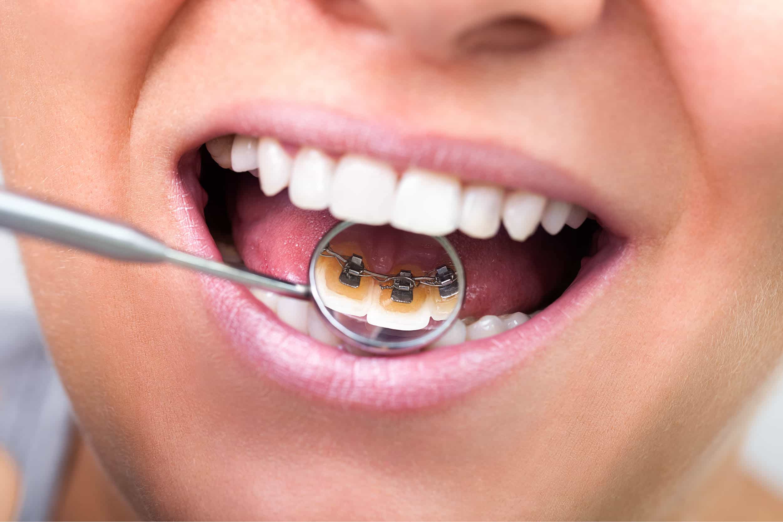 Behind the Smile: The Hidden Science of Lingual Orthodontics